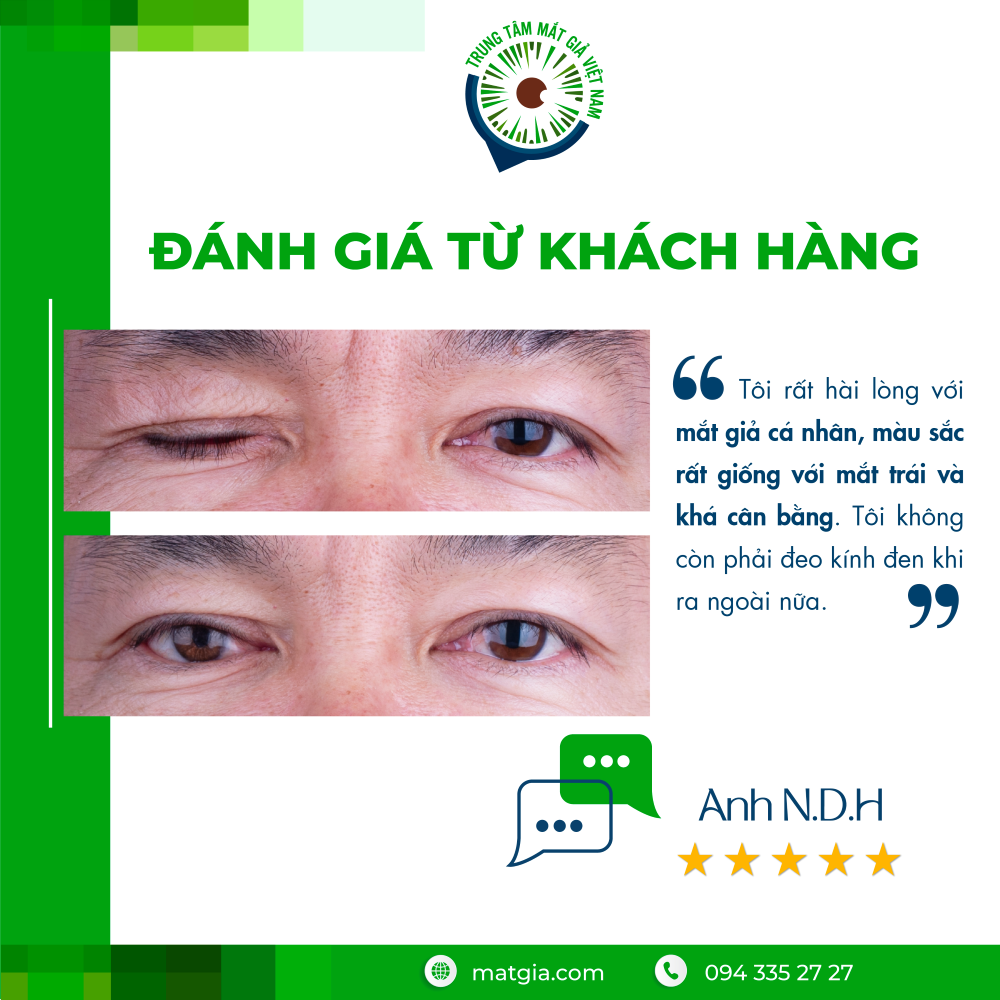 Cấu trúc mắt giả cá nhân - Matgia.com