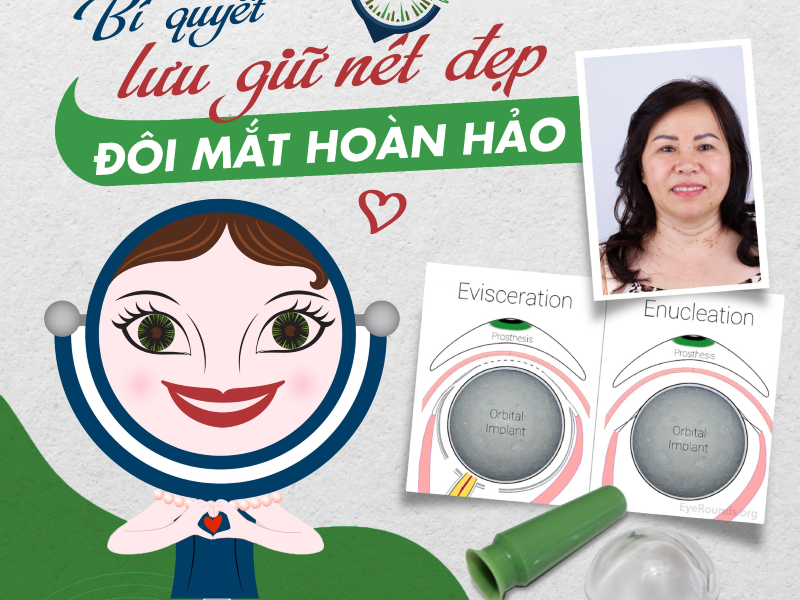 conformer là gì với phẫu thuật múc bỏ nhãn cầu - Matgia.com
