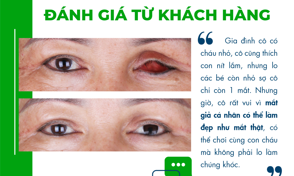 Đeo mắt giả không đúng kích thước phải làm sao - Matgia.com