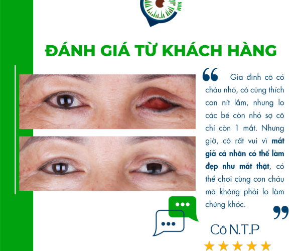Đeo mắt giả không đúng kích thước phải làm sao - Matgia.com