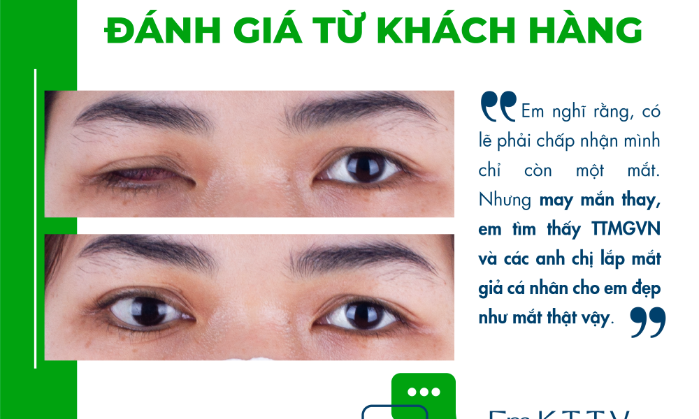Teo nhãn cầu và giải pháp lắp mắt giả - Matgia.com