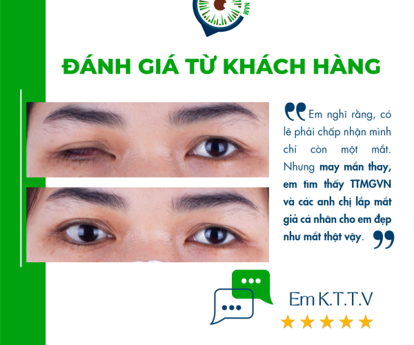 Teo nhãn cầu và giải pháp lắp mắt giả - Matgia.com