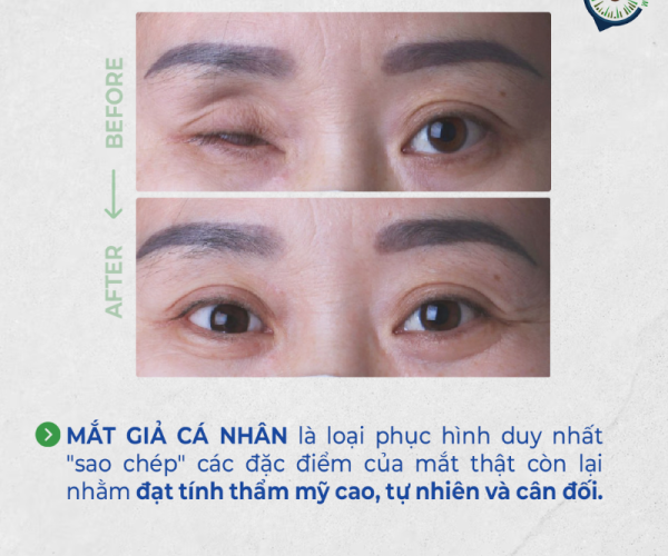Thay mắt giả hết bao nhiêu tiền? Chi phí và yếu tố ảnh hưởng - Matgia.com