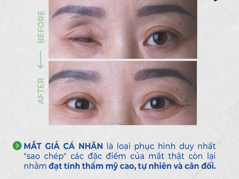 Thay mắt giả hết bao nhiêu tiền? Chi phí và yếu tố ảnh hưởng - Matgia.com