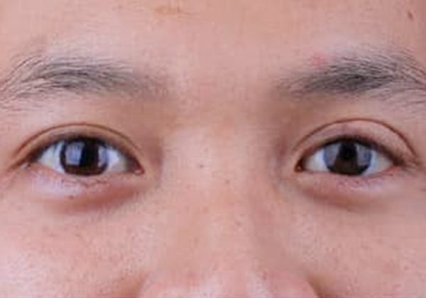 Hình ảnh trước và sau của khách hàng làm mắt giả - Hình sau