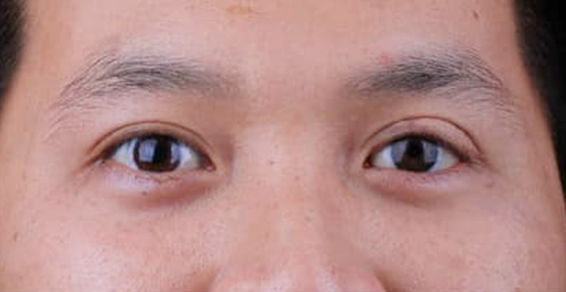 Hình ảnh trước và sau của khách hàng làm mắt giả - Hình sau