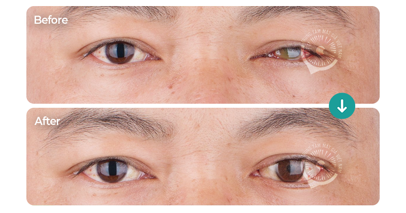 Ca lâm sàng 082417/TTMGVN – Mắt giả cá nhân 3D Super Thin