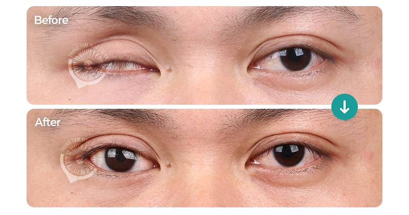 Ca lâm sàng 105731/TTMGVN – Mắt giả 3D Plus