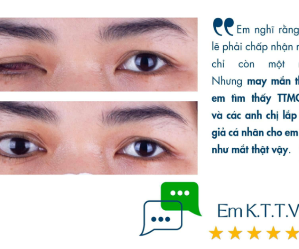 Phục hình mắt giả cá nhân cho người khiếm khuyết nhãn cầu
