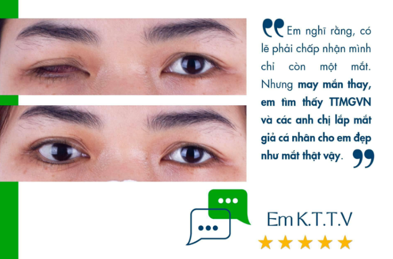 Phục hình mắt giả cá nhân cho người khiếm khuyết nhãn cầu Phục hình mắt giả cá nhân cho người khiếm khuyết nhãn cầu