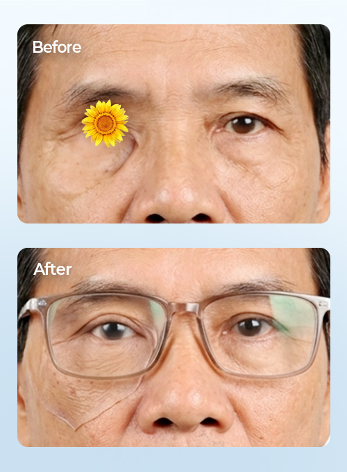 Mắt Giả Cá Nhân 3D Reskin Silicone giúp tái tạo diện mạo tự nhiên - Matgia.com