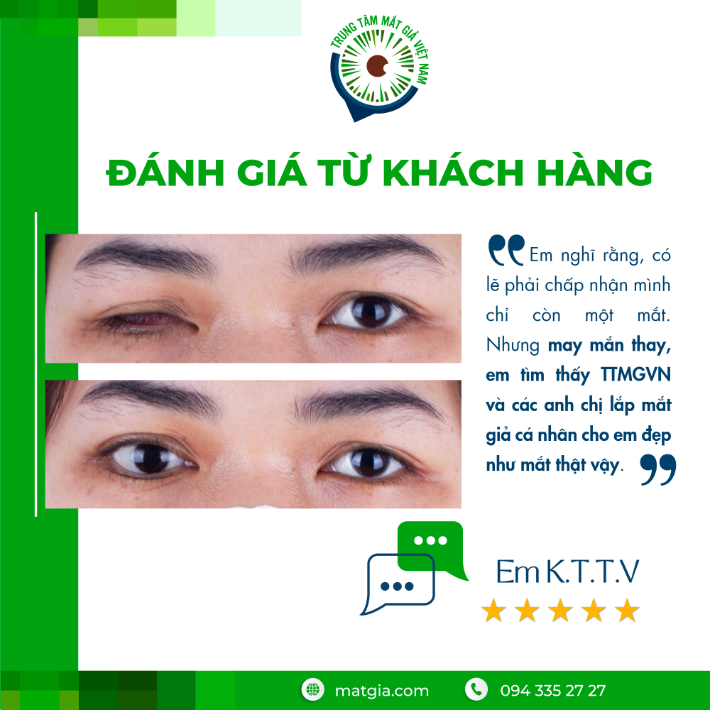 Teo nhãn cầu: Nguyên nhân, triệu chứng & giải pháp phục hình thẩm mỹ