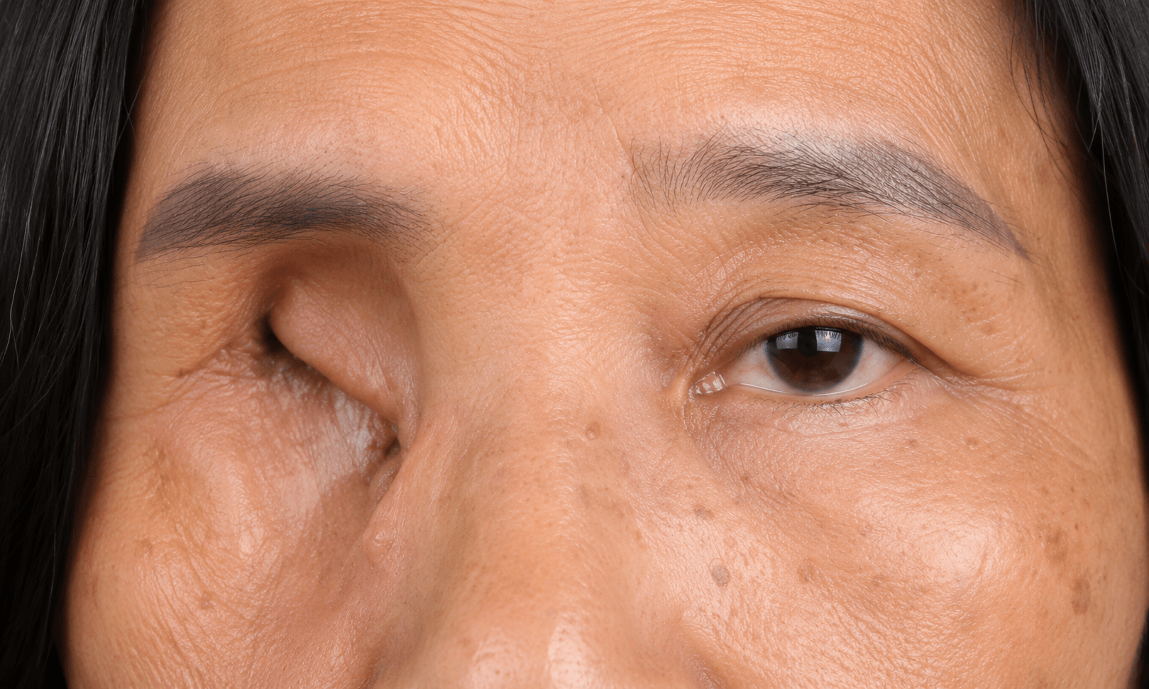 Mắt biến dạng do chấn thương